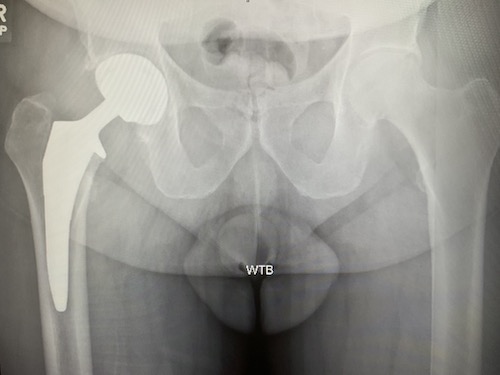 What Makes an Anterior Total Hip Different than a Posterior?