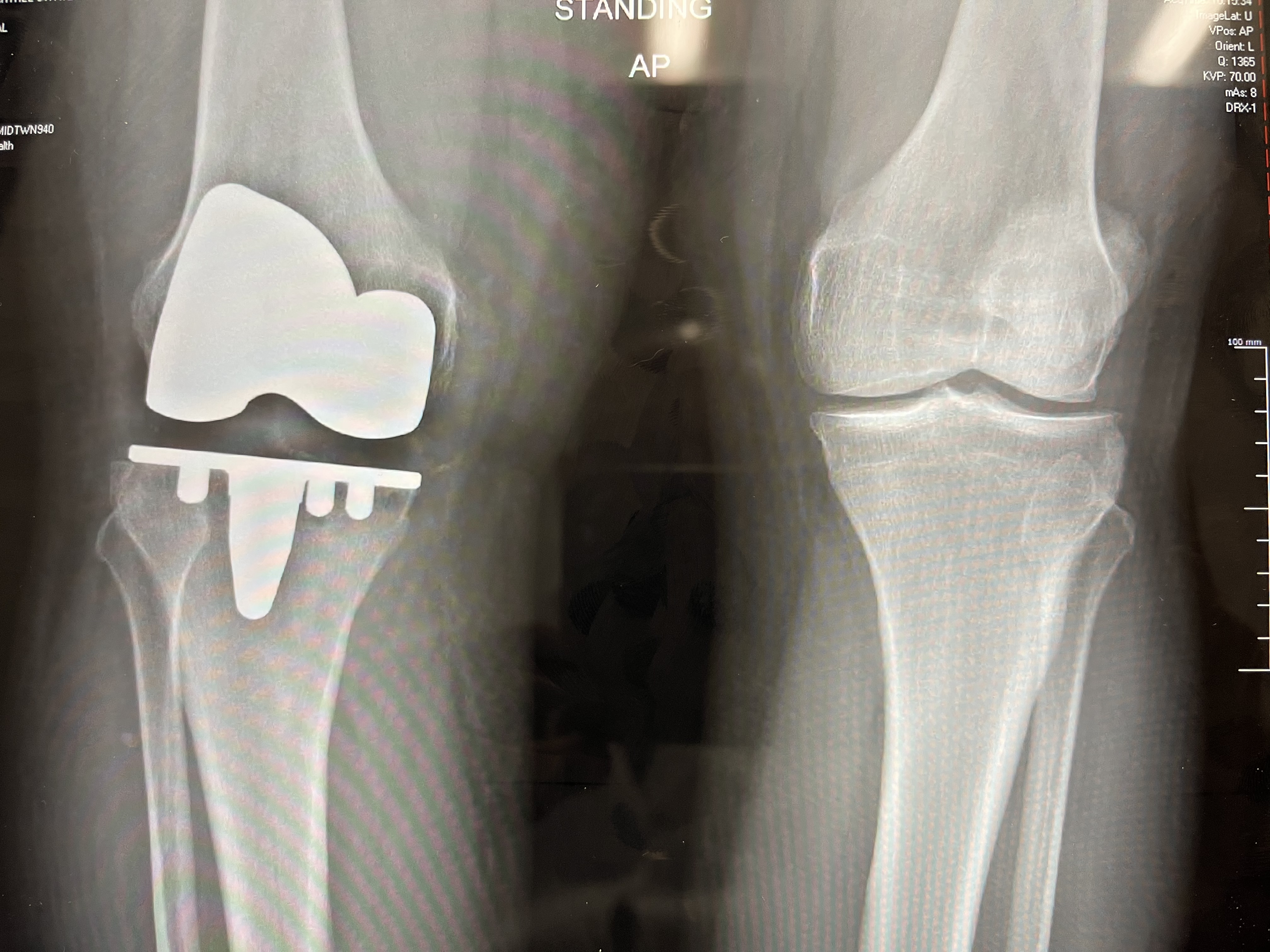 A Patient Specific Approach to Total Knee Replacement