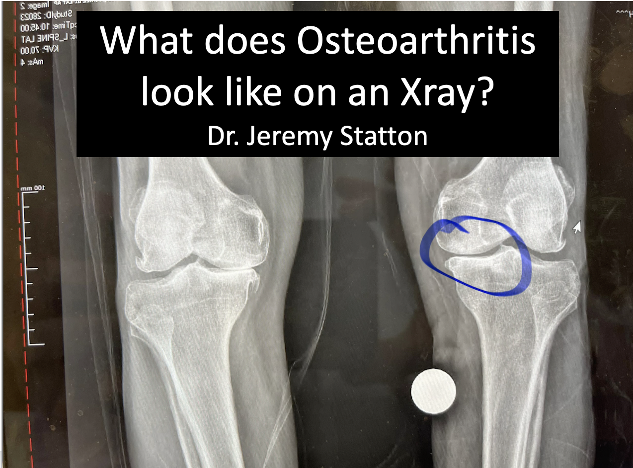 What does Osteoarthritis look like on an Xray?